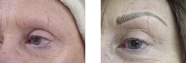 scar camoflauge with with permanent makeup