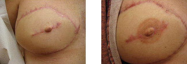 breast restoration with permanent makeup