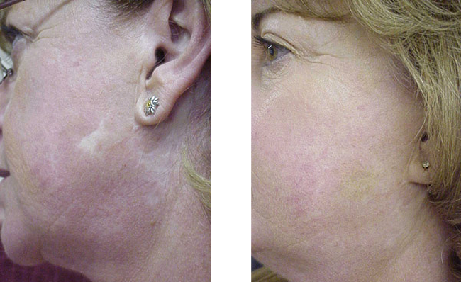 scar camoflauge with with permanent makeup
